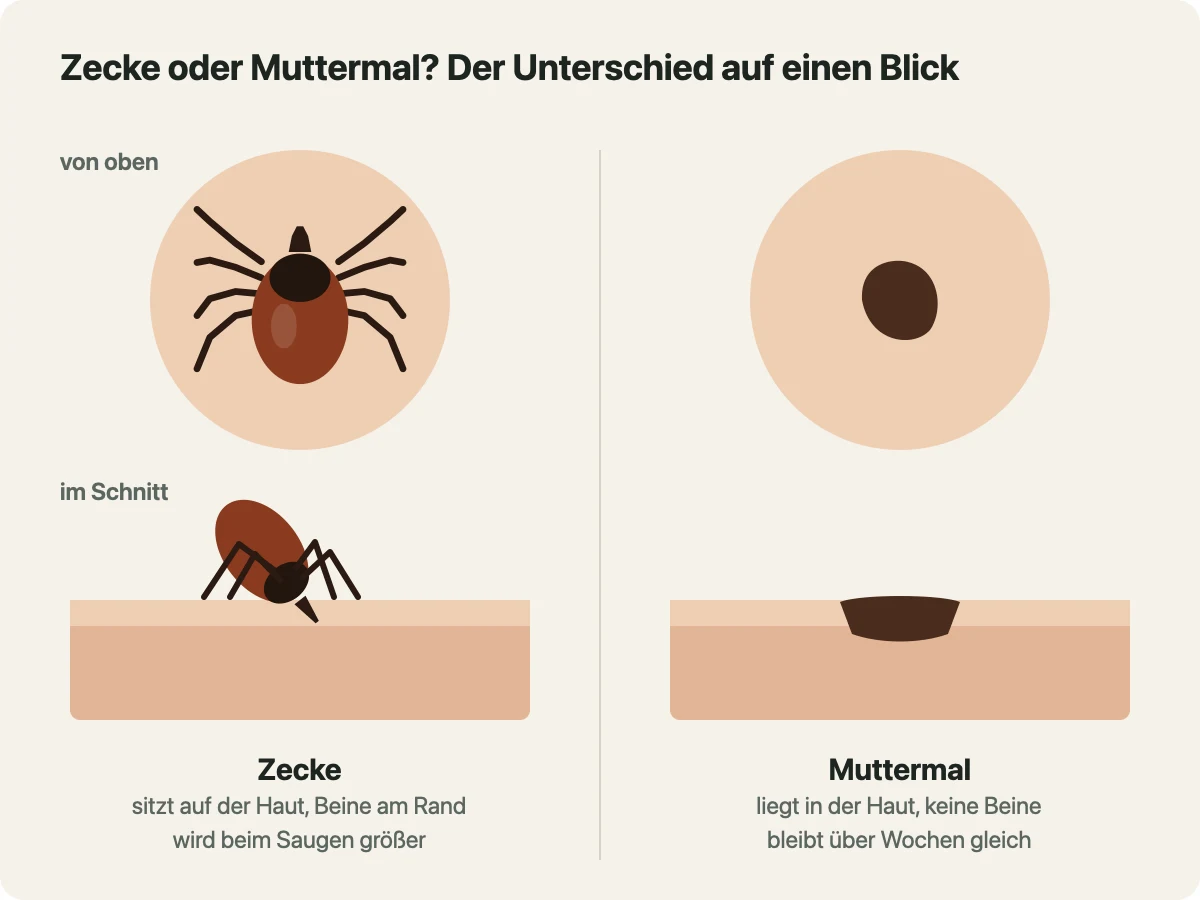 Vergleichszeichnung von oben und im Querschnitt durch die Haut: Die Zecke sitzt erhaben und schräg auf der Haut, mit Beinen am Rand und Mundwerkzeugen in der Haut; das Muttermal liegt flach in der Haut und hat keine Beine